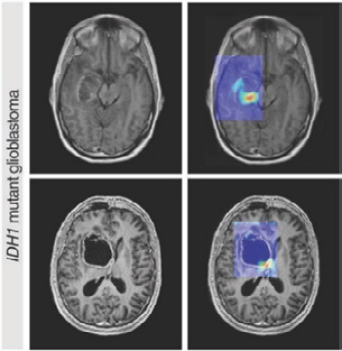 Figure 14.1﻿2 – MRI scans predicting the presence of an IDH1 gene mutation in brain tumors